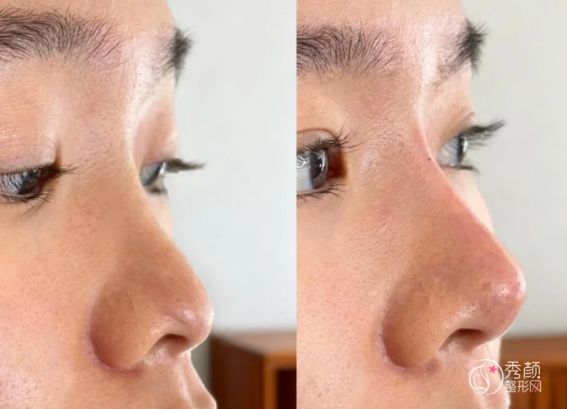 上海瑞金医院隆鼻多少钱？哪个医生好？隆鼻医生介绍