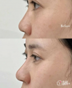 上海华山医院隆鼻多少钱