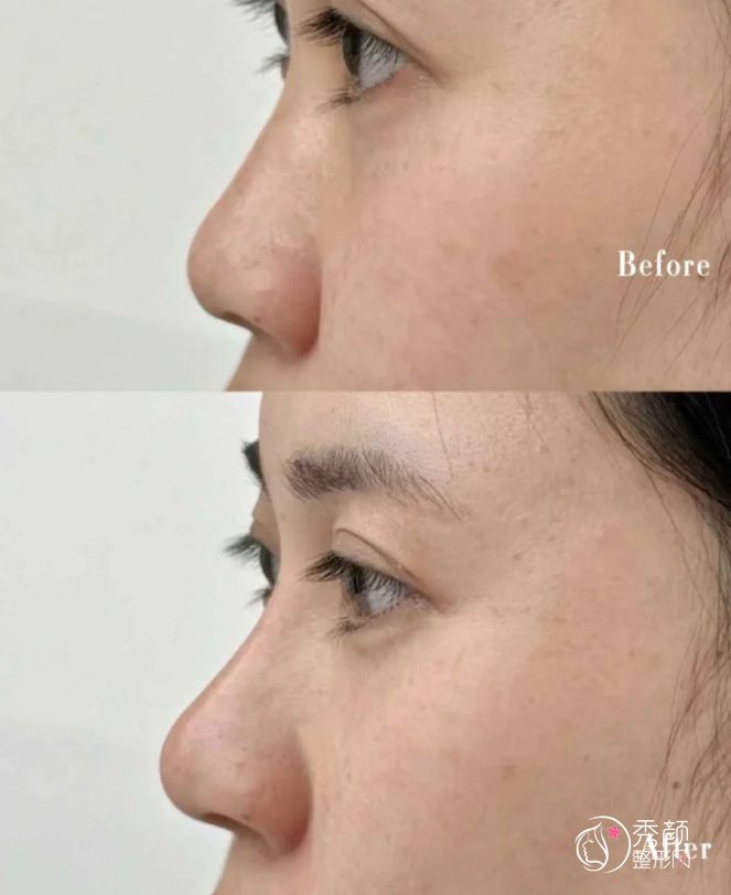 上海华山医院隆鼻多少钱？哪个医生好？隆鼻医生介绍