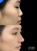 浙大一院隆鼻多少钱？哪