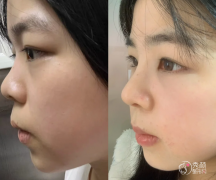 四川大学华西医院隆鼻多少钱？哪个医生好？隆鼻医生介绍