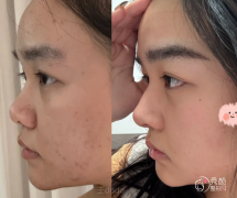 湘雅医院隆鼻多少钱？哪个医生好？隆鼻医生介绍