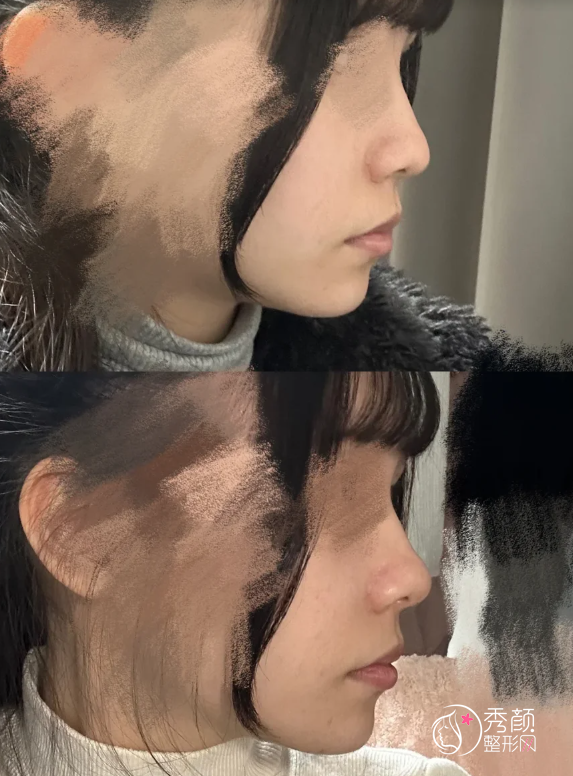 中山一院隆鼻多少钱？哪个医生好？隆鼻医生介绍