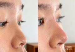 南方医院隆鼻多少钱？哪个医生好？隆鼻医生介绍