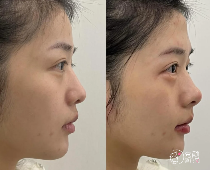 湘雅二医院隆鼻多少钱？哪个医生好？隆鼻医生介绍