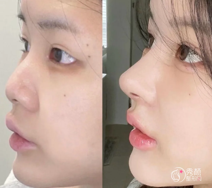 江苏省人民医院隆鼻多少钱？哪个医生好？隆鼻医生介绍