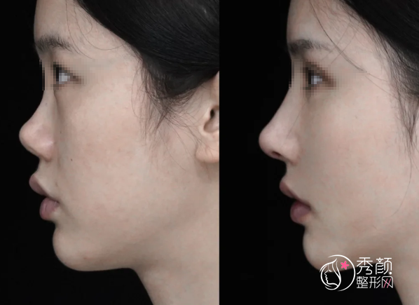 上海九院隆鼻多少钱？哪个医生好？隆鼻医生介绍