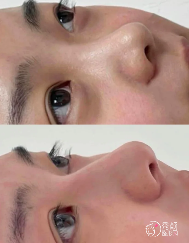 北京八大处隆鼻多少钱？哪个医生好？隆鼻医生介绍