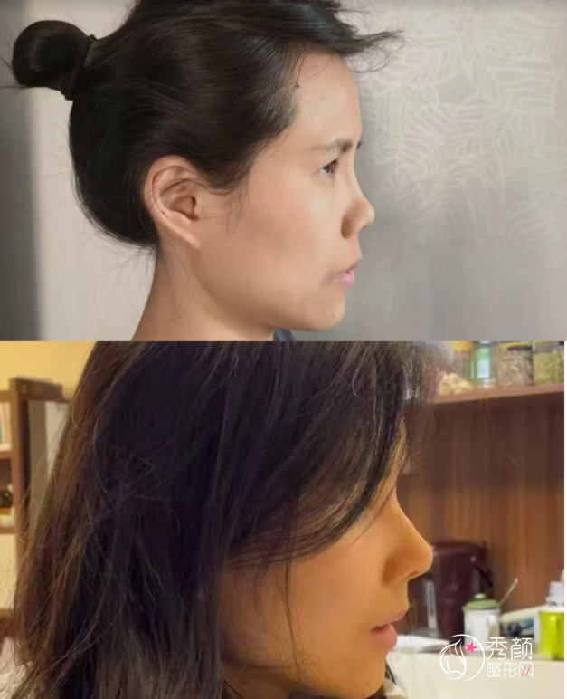 北医三院隆鼻多少钱？哪个医生好？隆鼻医生介绍