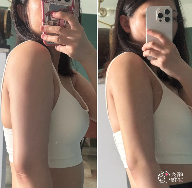 郑大一附院吸脂多少钱？哪个医生好？吸脂医生介绍