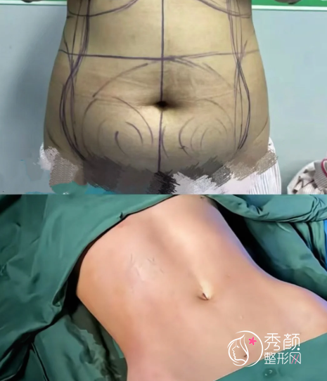 江苏省人民医院吸脂多少钱？哪个医生好？吸脂医生介绍