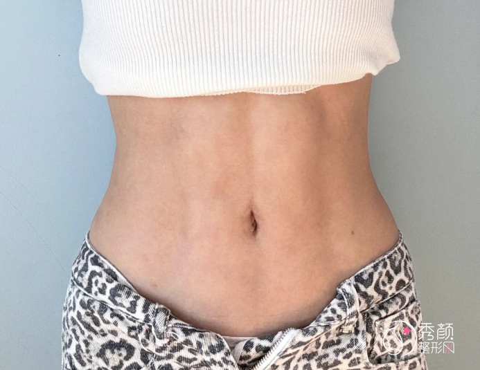 北京大学人民医院吸脂多少钱？哪个医生好？李广学等吸脂医生介绍