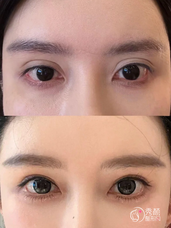 上海九院双眼皮多少钱？哪个医生好？丁伟等双眼皮医生介绍