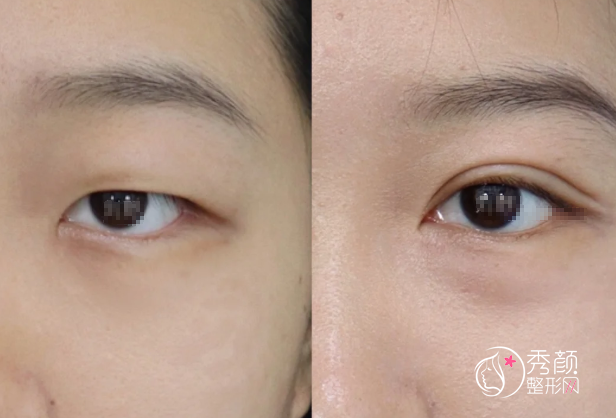 北京友谊医院双眼皮多少钱？哪个医生好？王友彬等双眼皮医生介绍