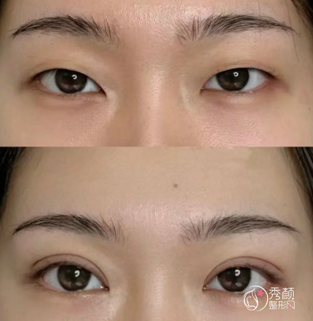 上海华山医院双眼皮多少钱？哪个医生好？丁志等双眼皮医生介绍