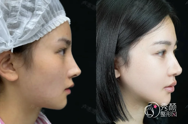 北京协和医院鼻修复多少钱？哪个医生好？龙飞、王阳等鼻修复医生介绍