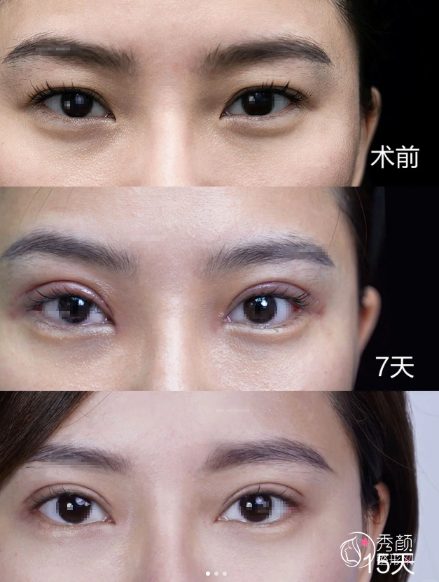 四川大学华西医院双眼皮多少钱？哪个医生好？卿勇、李正勇等双眼皮医生介绍