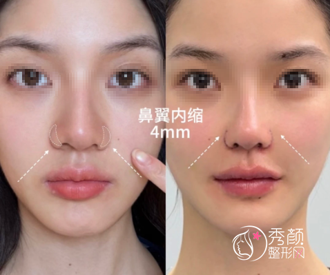 东南大学附属中大医院鼻翼缩小多少钱？哪个医生好？鼻翼缩小医生介绍