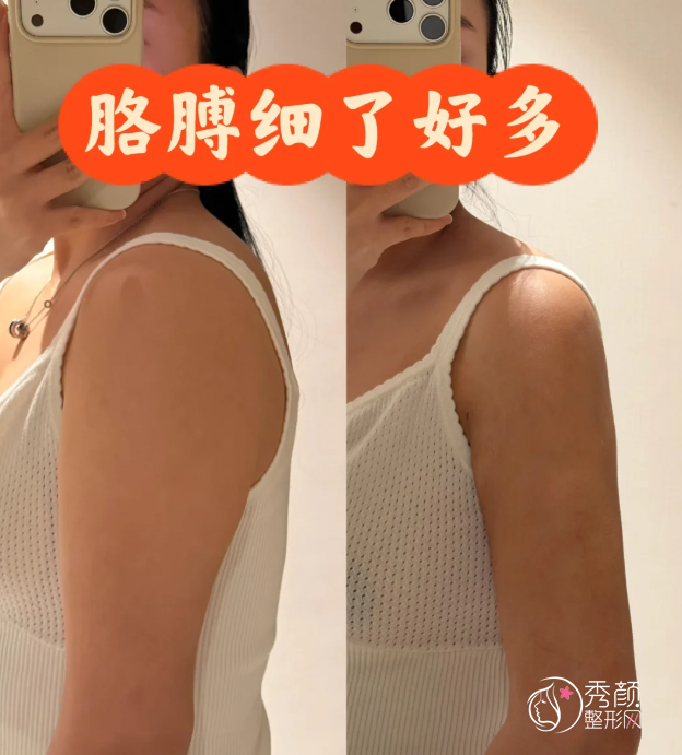 北京安贞医院吸脂多少钱，哪个医生好？李斌斌等吸脂医生介绍