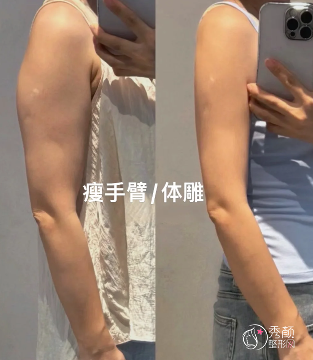 上海市第一人民医院吸脂多少钱，哪个医生好？汪汇等吸脂医生介绍