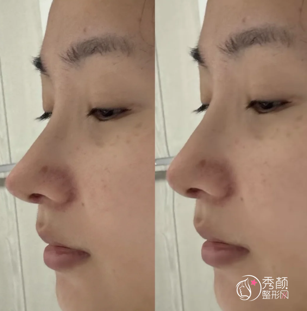 宁波大学附属第一医院隆鼻多少钱,哪个医生好?胡文波等隆鼻医生介绍