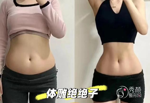 中山大学附属第三医院吸脂多少钱，哪个医生好？朱蕾等吸脂医生介绍