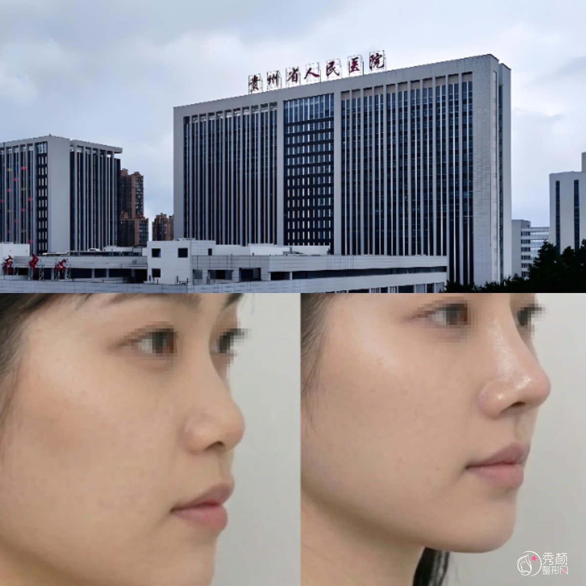 贵州省人民医院整形科价格表曝光，双眼皮2000元起，隆鼻8000元起