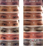 北京双眼皮手术分几种类型?每种类型适合什么样的人?