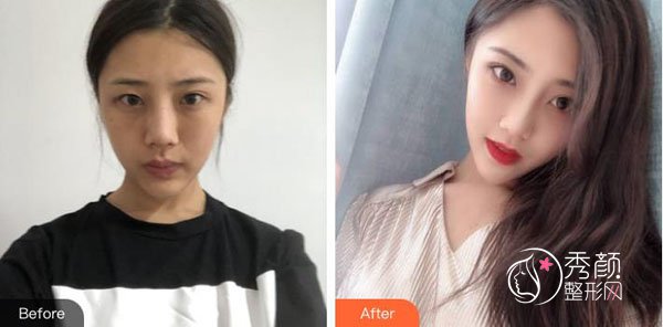 北京去眼袋微创手术大概多少钱？大致6800元起，这两大公立医院可挑