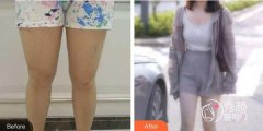 上海吸脂手术大概要多少钱？大致4000元起，两家性价比高的医院盘点