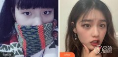 北京双眼皮修复是不是重新做一次？分情况，轻微调整或是重做