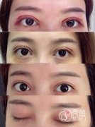 成都双眼皮修复多久可以做第二次？术后半年后再修复，附案例