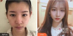 郑州隆鼻假体可以一辈子不取吗？不一定，分情况看，附热门医院点评