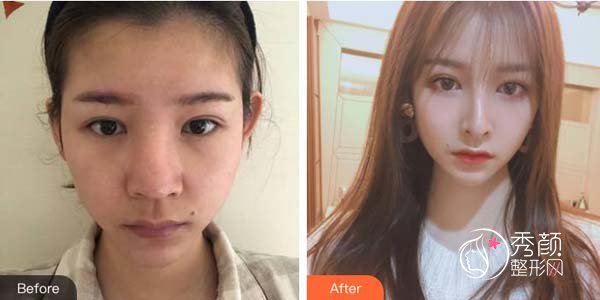 郑州隆鼻假体可以一辈子不取吗？不一定，分情况看，附热门医院点评