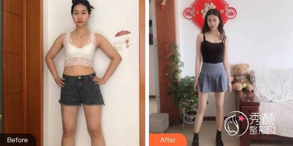 广州大腿吸脂后多久恢复正常？有副作用吗？