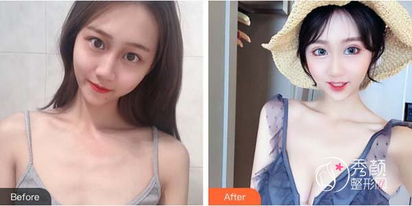 广州自体脂肪隆胸价钱多少？费用大致在4万元起，多家医美机构可开展