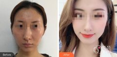 宁波颧骨内推多久恢复自然？3~6个月恢复自然，手术费用参考4万元起