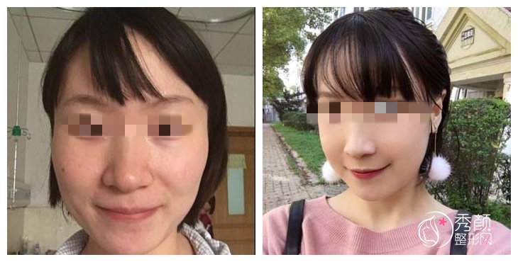 太原颧骨内推和磨骨有什么区别？颧骨内推和磨骨能一起操作吗？