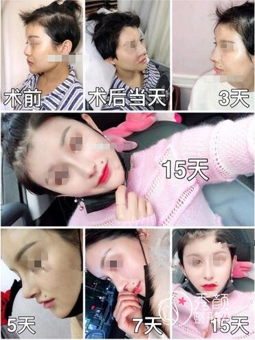 杭州鼻修复肋骨好还是超