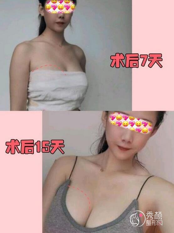 广州自体脂肪隆胸价钱多少？费用大致在4万元起，多家医美机构可开展