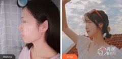 苏州下颌角磨骨手术多少钱？参考2.5万元起，受面部基础等影响