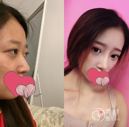 无锡歪鼻矫正手术风险大吗？风险大小与鼻部基础情况等因素有关