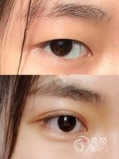 常州双眼皮埋线能保持多长时间？3~5年左右，内含双眼皮埋线原理解析