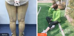 南京大腿吸脂后多久消肿变瘦？7~10天消肿变瘦，完全恢复要2个月