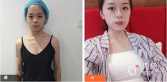 东莞脂肪隆胸和假体隆胸哪个安全？两种主流隆胸方式对比展示