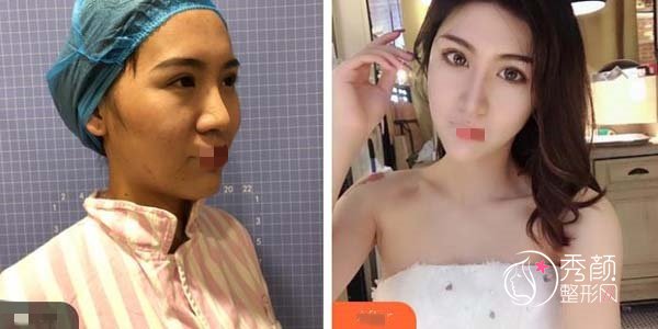 南宁假体隆鼻和肋骨鼻哪个更符合年轻人审美？可制定个性化方案