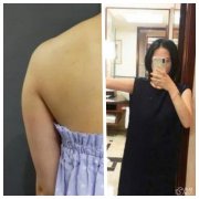 长沙手臂吸脂的危害有哪些？针孔感染、毛细血管受损、手臂凹凸不平