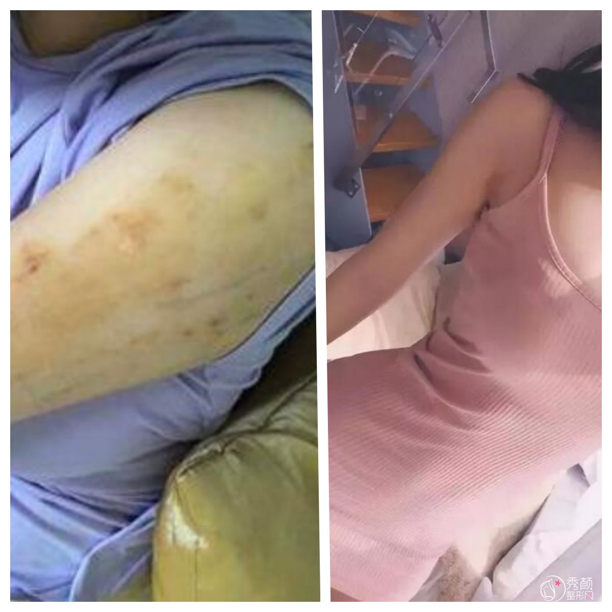 西安手臂吸脂手术恢复期多久？西安手臂吸脂哪家好？