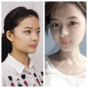 天津磨骨有什么危害和后遗症？面部麻木、面部左右不对称…