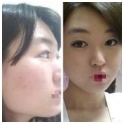 南京磨骨手术恢复期多久？南京磨骨手术常见的有哪几种？
